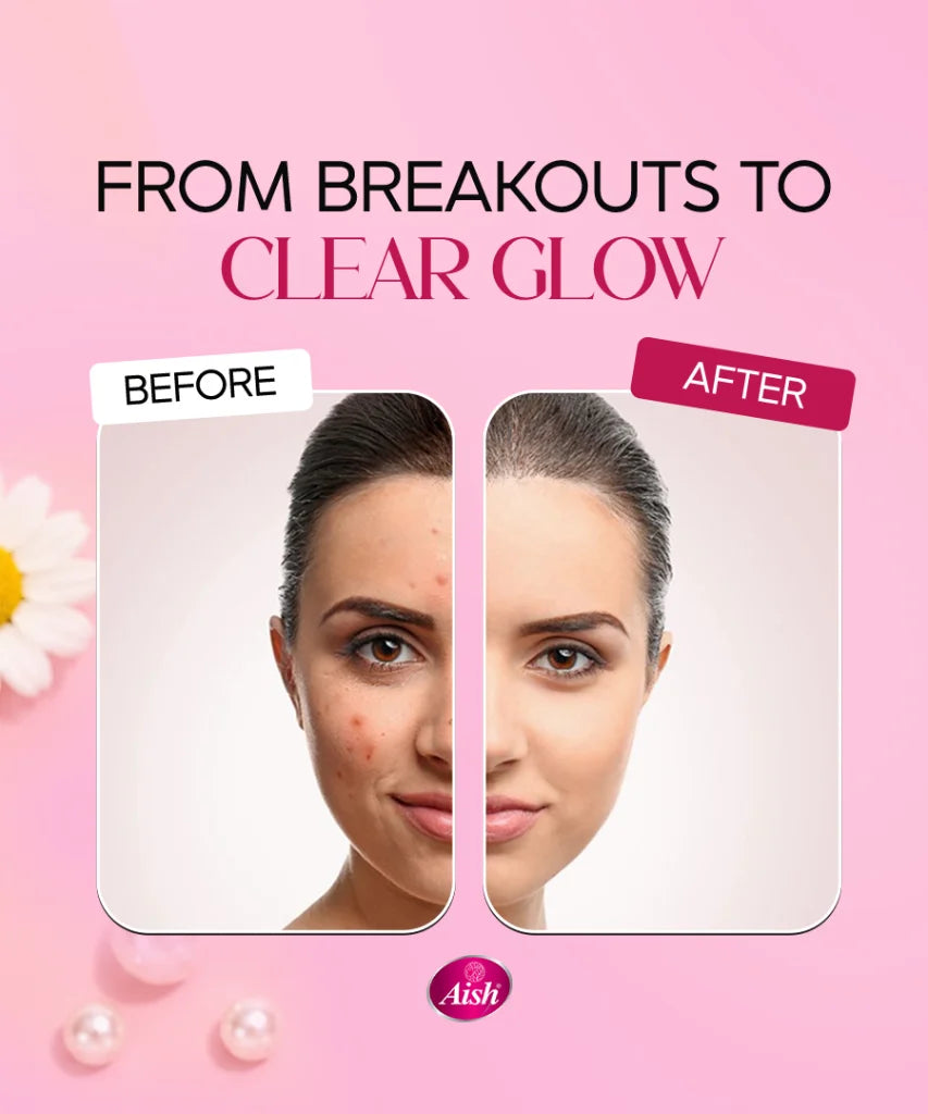 ANTI ACNE CREAM 20GRM